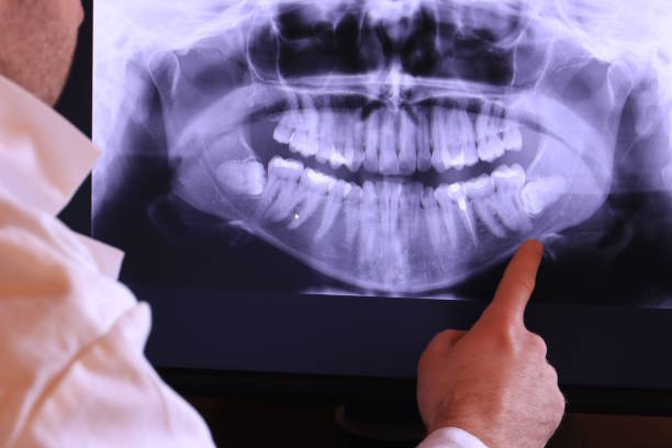 Best Dental Abscess Treatment in St Marys, OH