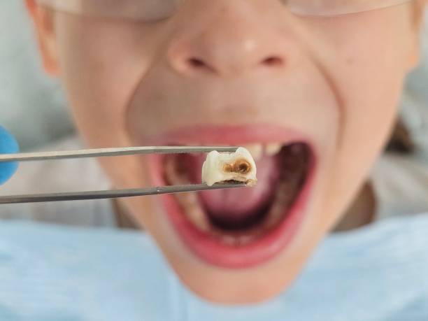 Best Emergency Treatment for Oral Infections in St Marys, OH